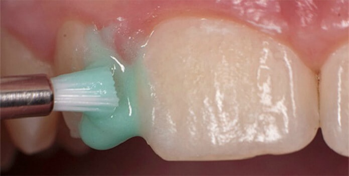 восстановление эмали зубов