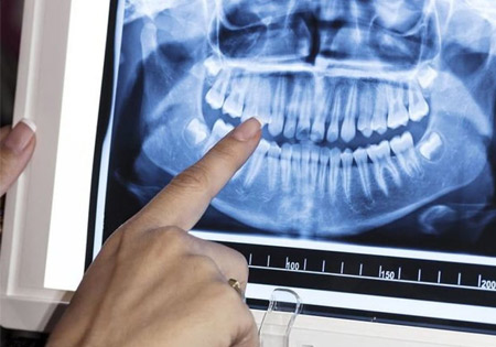 Как делают рентген зуба, фото Eurodent