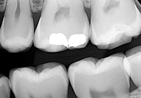 Рентген зуба, фото Eurodent