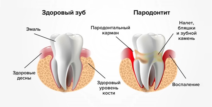 Пародонтит после зубного налета, фото