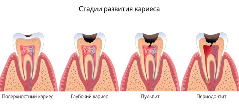 На изображении стадии развития кариеса зубов, Евродент фото 1