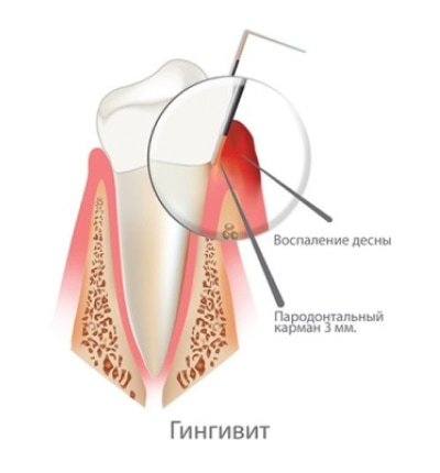 На изображении схематическое строение зуба в разрезе, на котором показан гингивит, Евродент фото