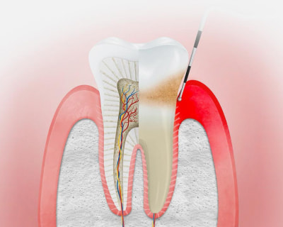 Изображения воспаленного зуба, фото Евродент