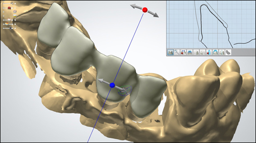 Моделирование ортодонтической системы на 3d модели зубов, фото Евродент